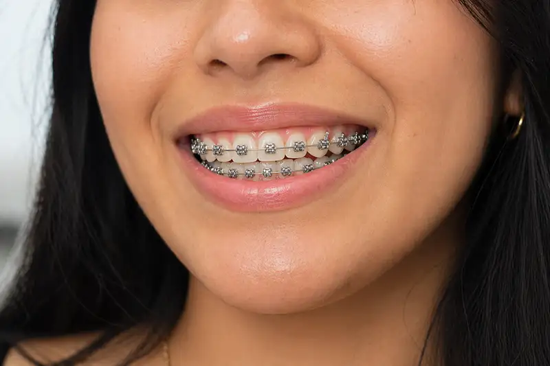 Brackets metálicos en ambato