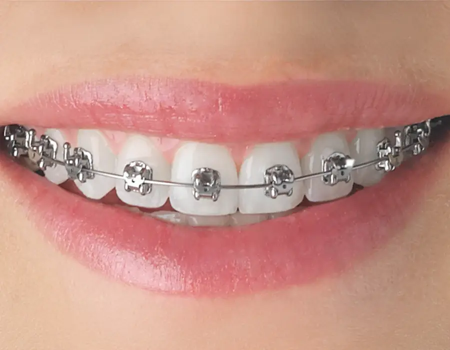 brakets de Autoligado