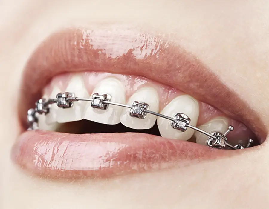 Brakets para los dientes