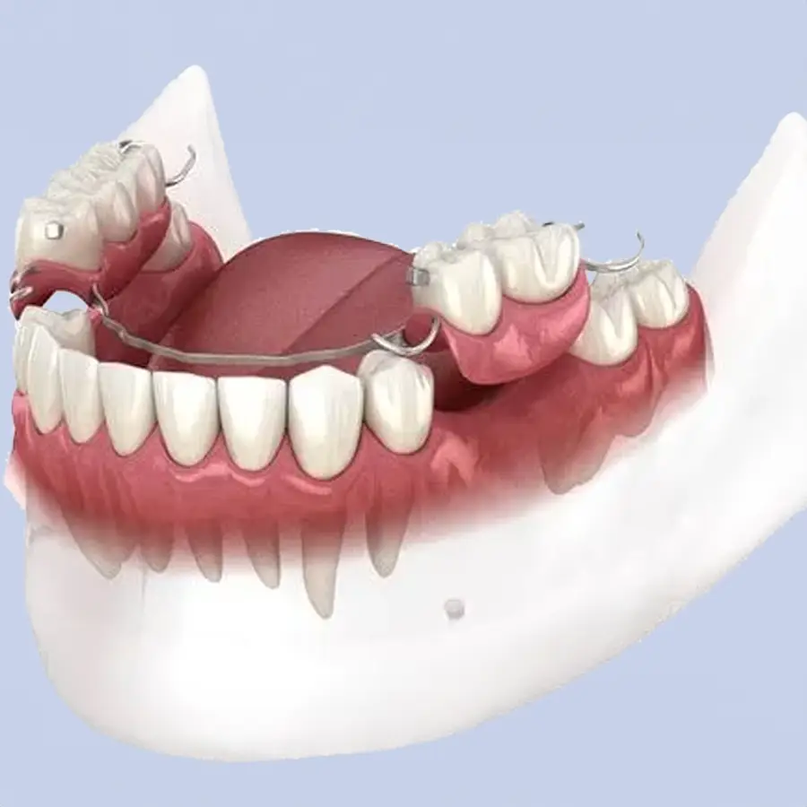 dentadura Postiza parcial