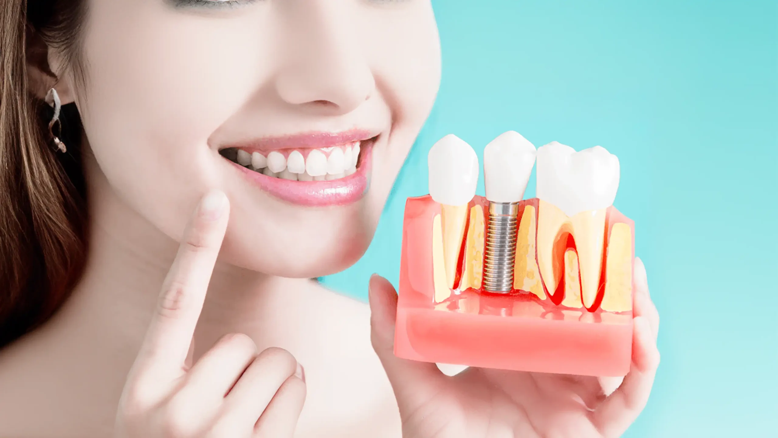 Implantes Dentales en Ambato