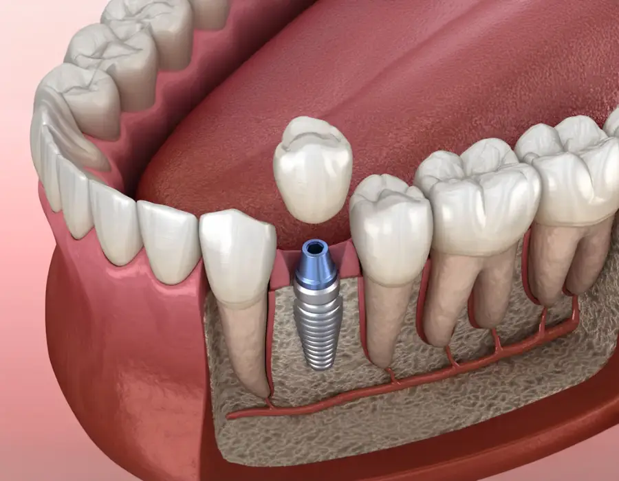 Implantes Dentales en Ambato