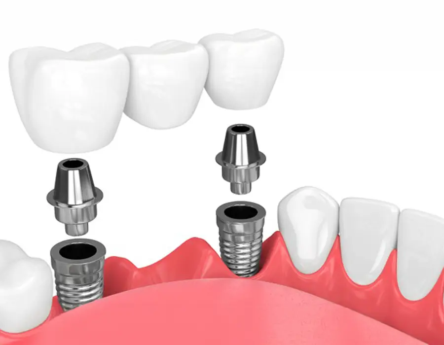 Implantes Dentales en Ambato