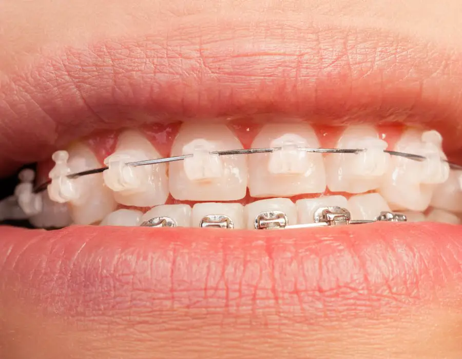 Brakets de porcelana