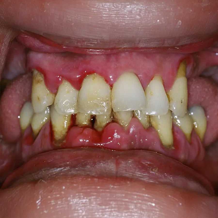 Periodontitis Agresiva