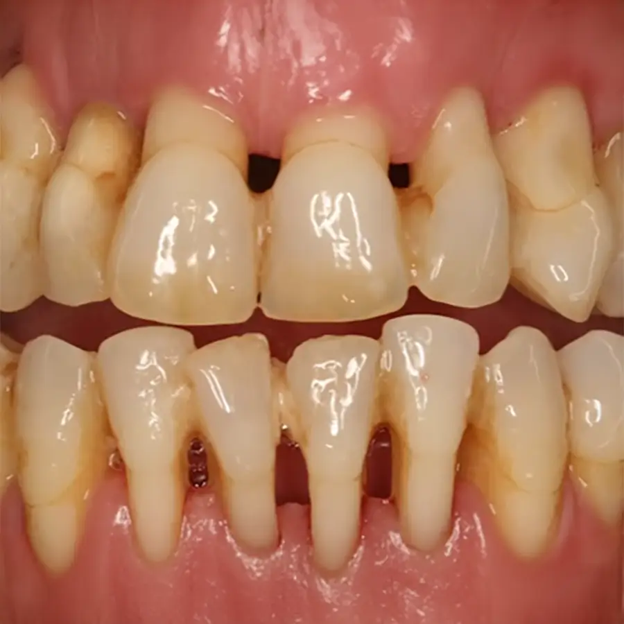 Periodontitis