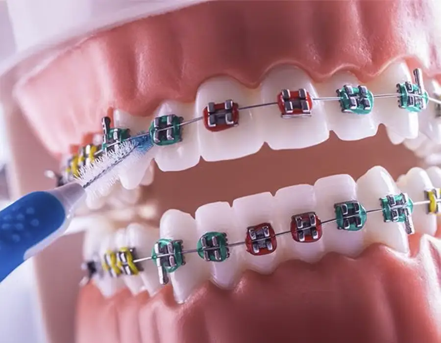 Brakets Internos