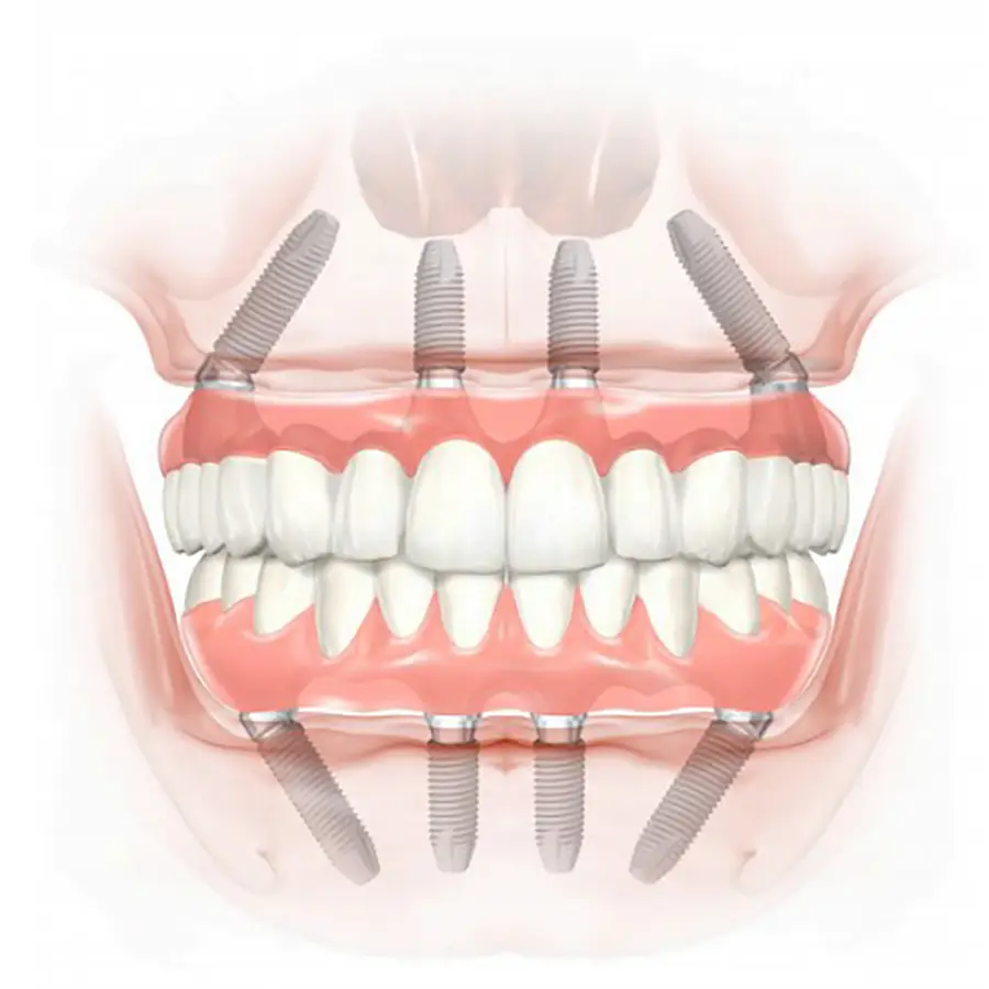 Protesis dentales soportadas por implantes dentales