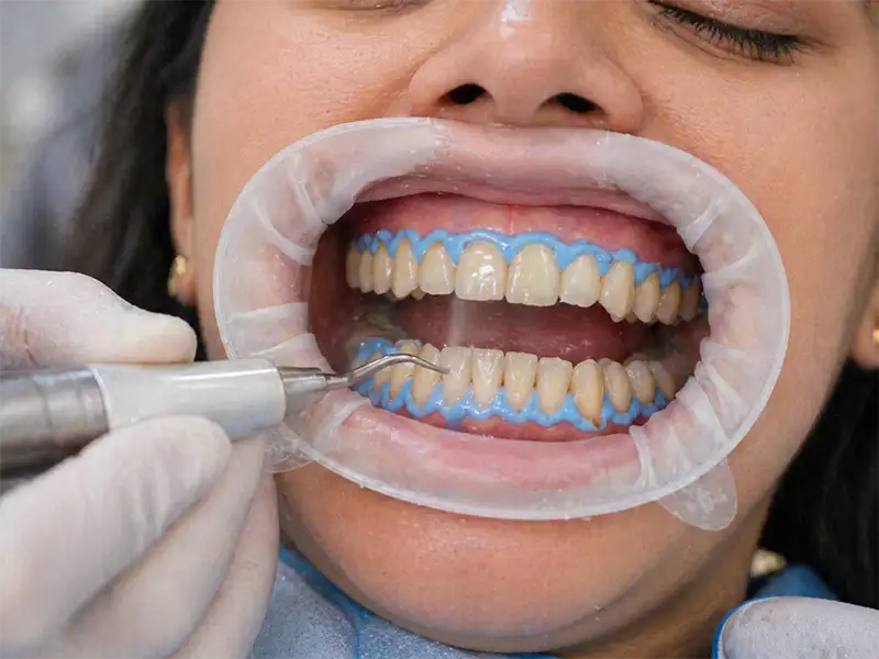 Blanqueamiento dental en Ambato