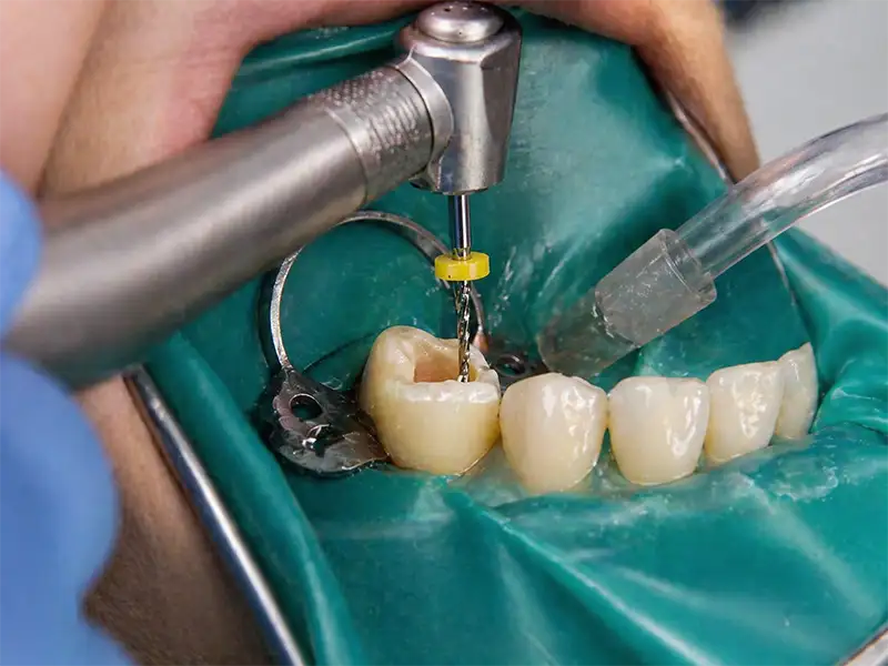 Endodoncia en Ambato 1