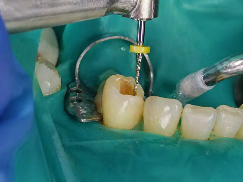 Endodoncia en Ambato