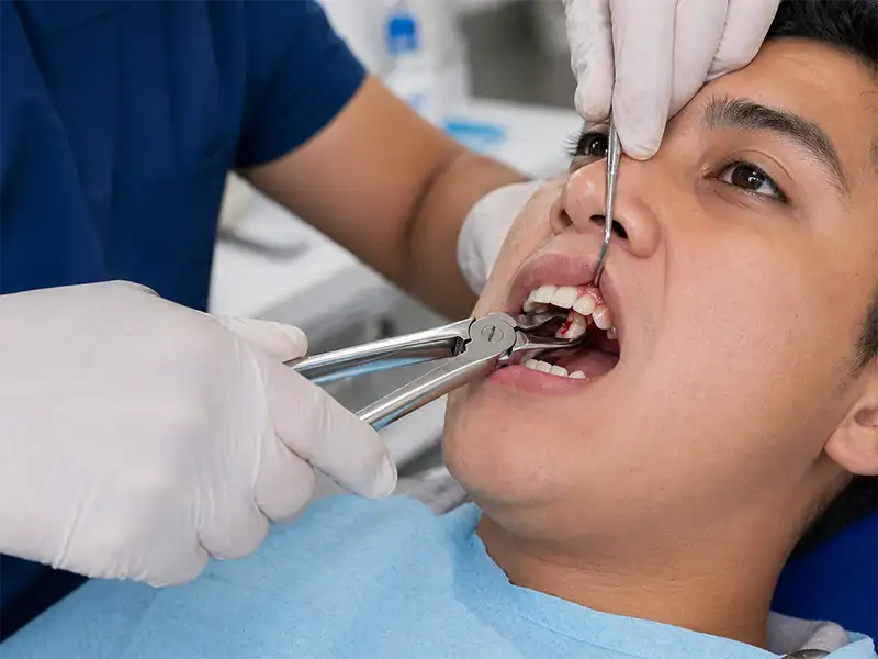 Extracción de Muela del Juicio en Ambato 1