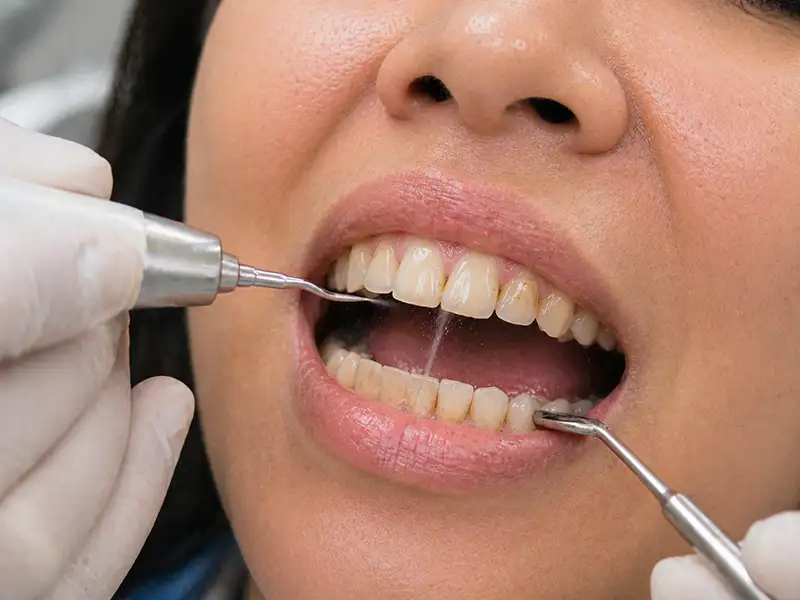 Limpieza Dental en Ambato