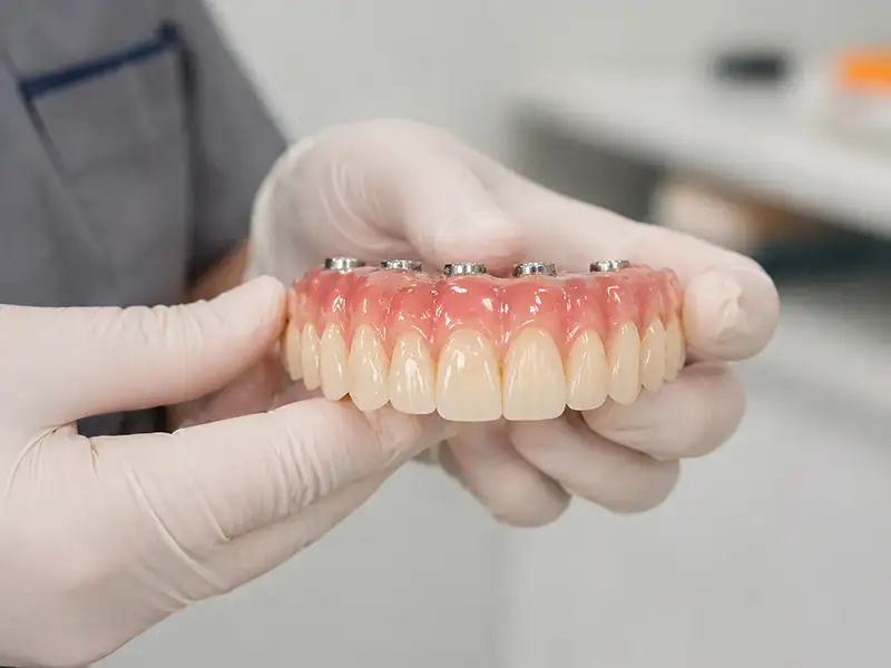 Implantes Dentales en Ambato 1