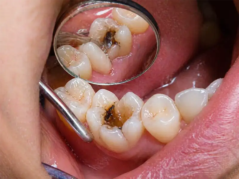 Restauraciones Dentales en Ambato