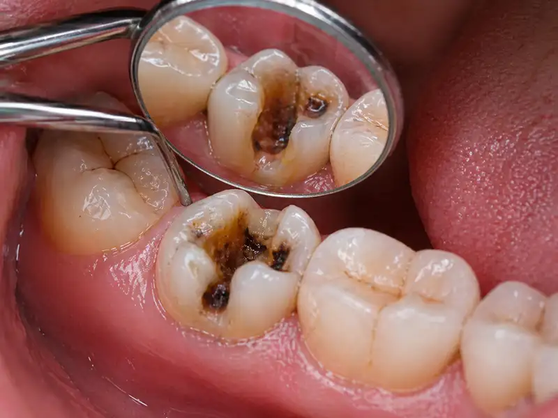 restauraciones dentales en Ambato